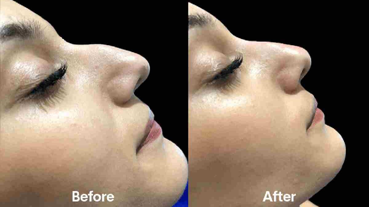 Non Surgical Nose Job – Process of Non-Surgical Nose Job