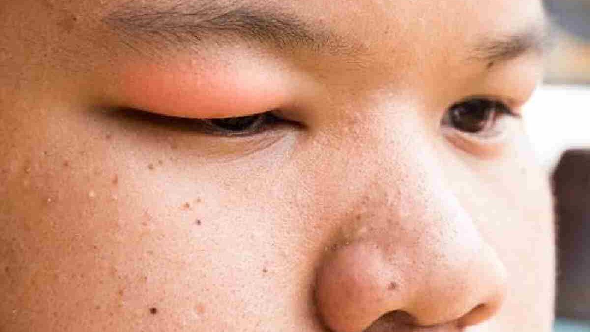 What is the Fastest Way to Heal a Swollen Eyelid?