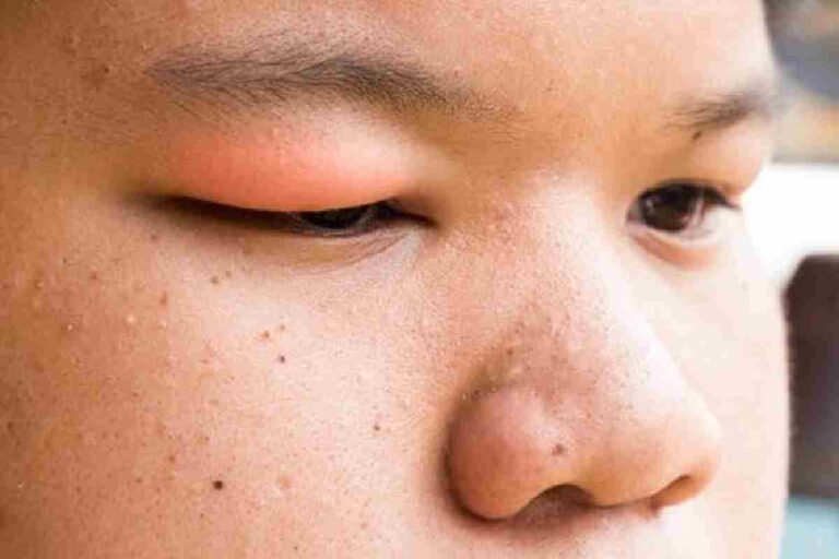 What is the Fastest Way to Heal a Swollen Eyelid? – Describes